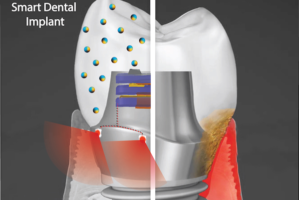 Smart Dental Implants